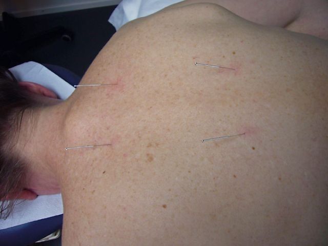 Patient bekommt eine Rücken-Akupunktur
