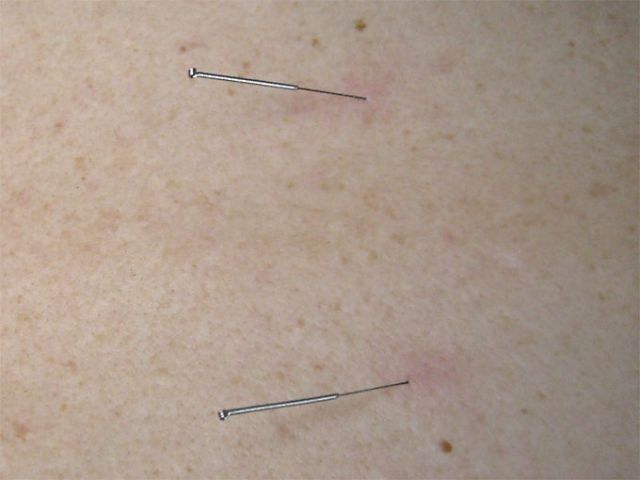 Patient bekommt eine Rücken-Akupunktur