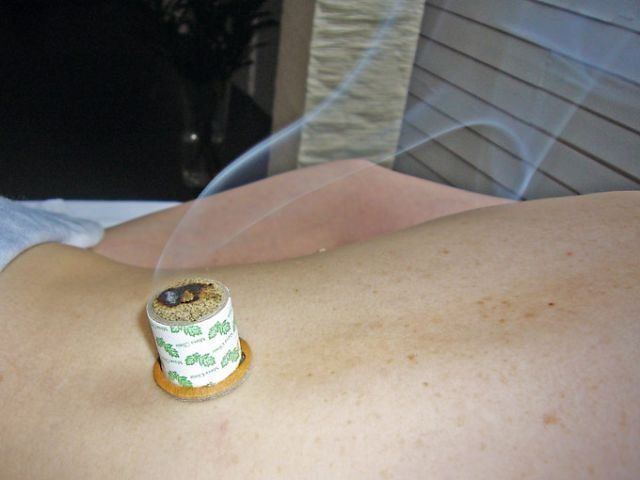 Patient bekommt Moxibustion