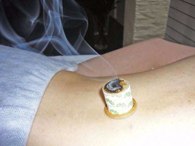 Patient bekommt Moxibustion