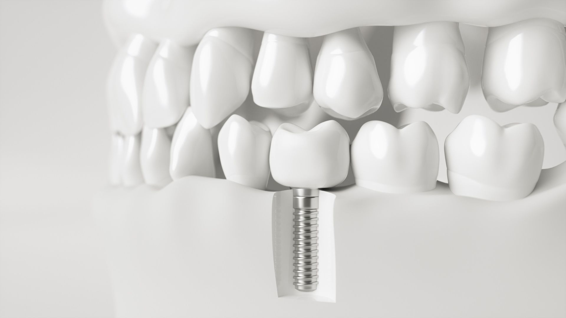 Un primer plano de un diente con un implante dental.