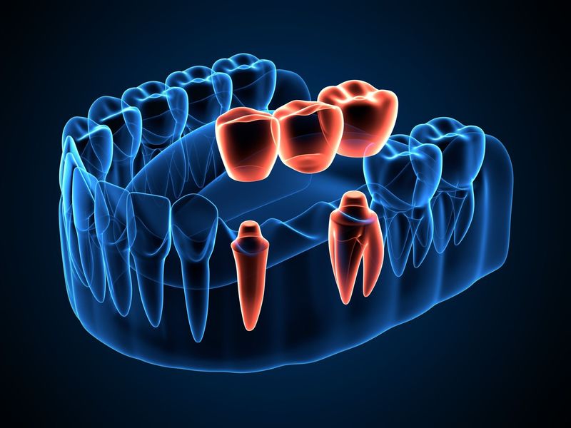 Una imagen generada por computadora de un puente dental con dientes rojos.