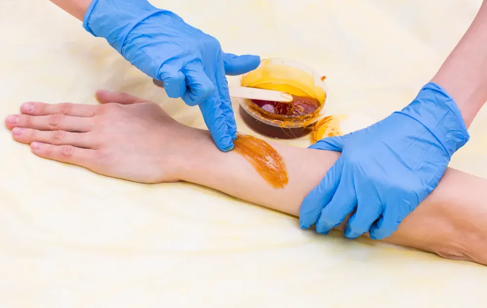 Manos con guantes médicos azules que aplican cera depilatoria de color ámbar en el antebrazo de una persona.