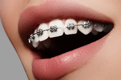 Un primer plano de la boca de una mujer con aparatos dentales.