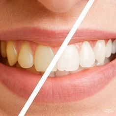 Una fotografía de antes y después de los dientes de una mujer.