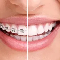 Un primer plano de los dientes de una mujer antes y después de los aparatos ortopédicos.