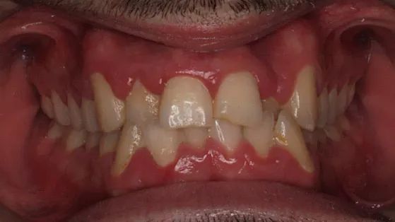 Un primer plano de los dientes y las encías de una persona.