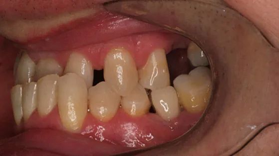 Un primer plano de la boca de una persona a la que le faltan dientes.