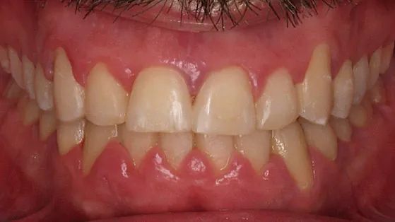 Un primer plano de los dientes y la boca de una persona.
