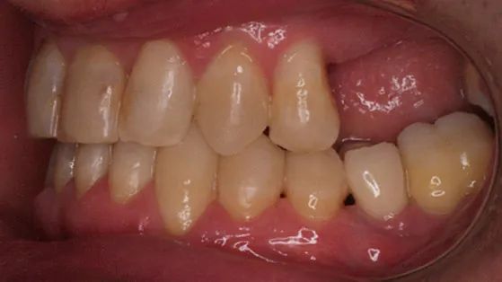 Un primer plano de los dientes y las encías de una persona.