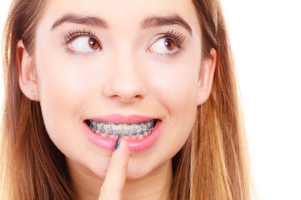 Un primer plano de una mujer con aparatos dentales.