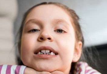 Una niña con aparatos dentales mira a la cámara.