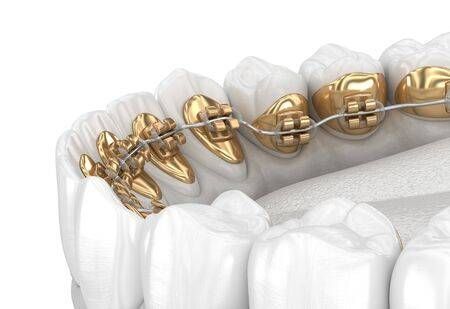 Un primer plano de los dientes de una persona con aparatos de oro.