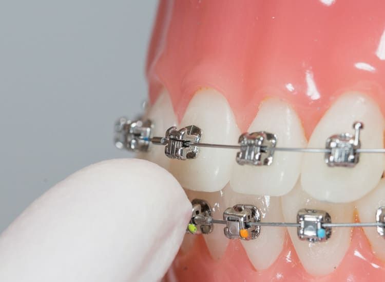 Una persona sostiene un modelo de los dientes de una persona con aparatos ortopédicos.