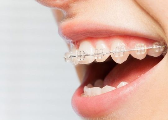 Una mujer lleva aparatos dentales y sonríe.