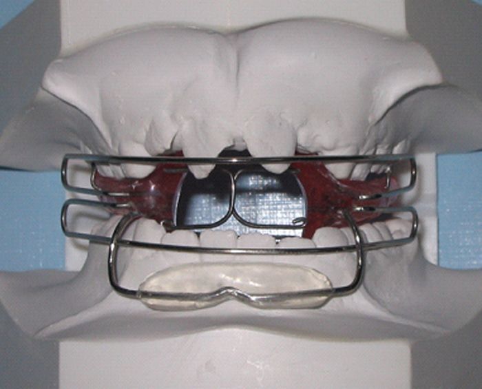 Un modelo de los dientes de una persona con aparatos ortopédicos.