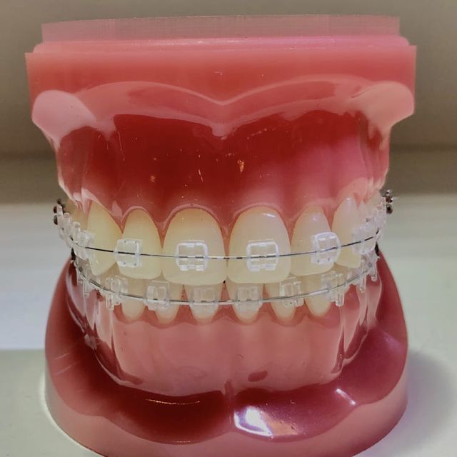 Un modelo de los dientes de una persona con aparatos transparentes.