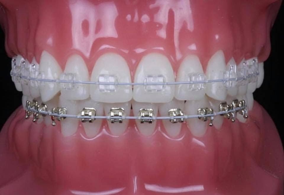 Un primer plano de un modelo de los dientes de una persona con aparatos ortopédicos.