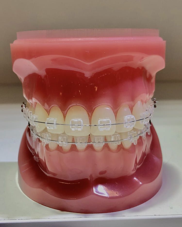 Un modelo de los dientes de una persona con aparatos transparentes.