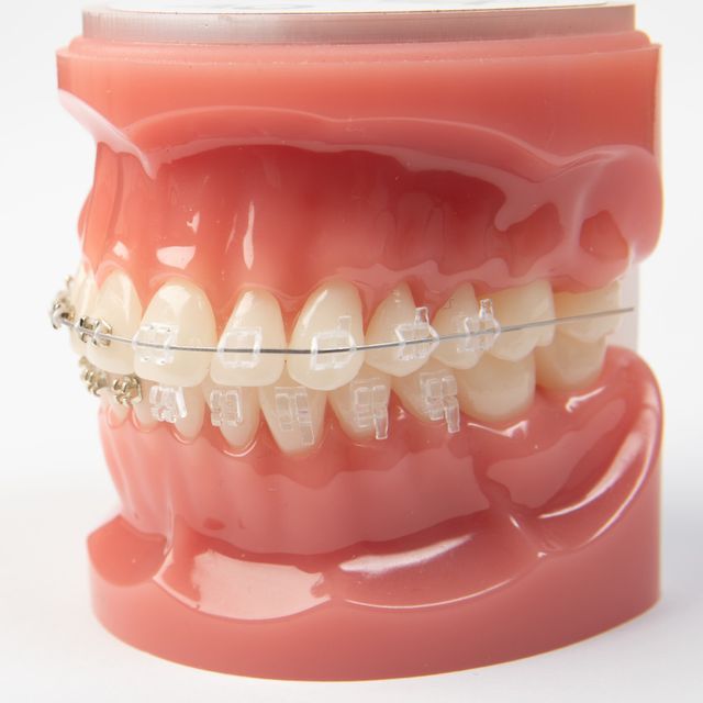 Un modelo de los dientes de una persona con aparatos transparentes.