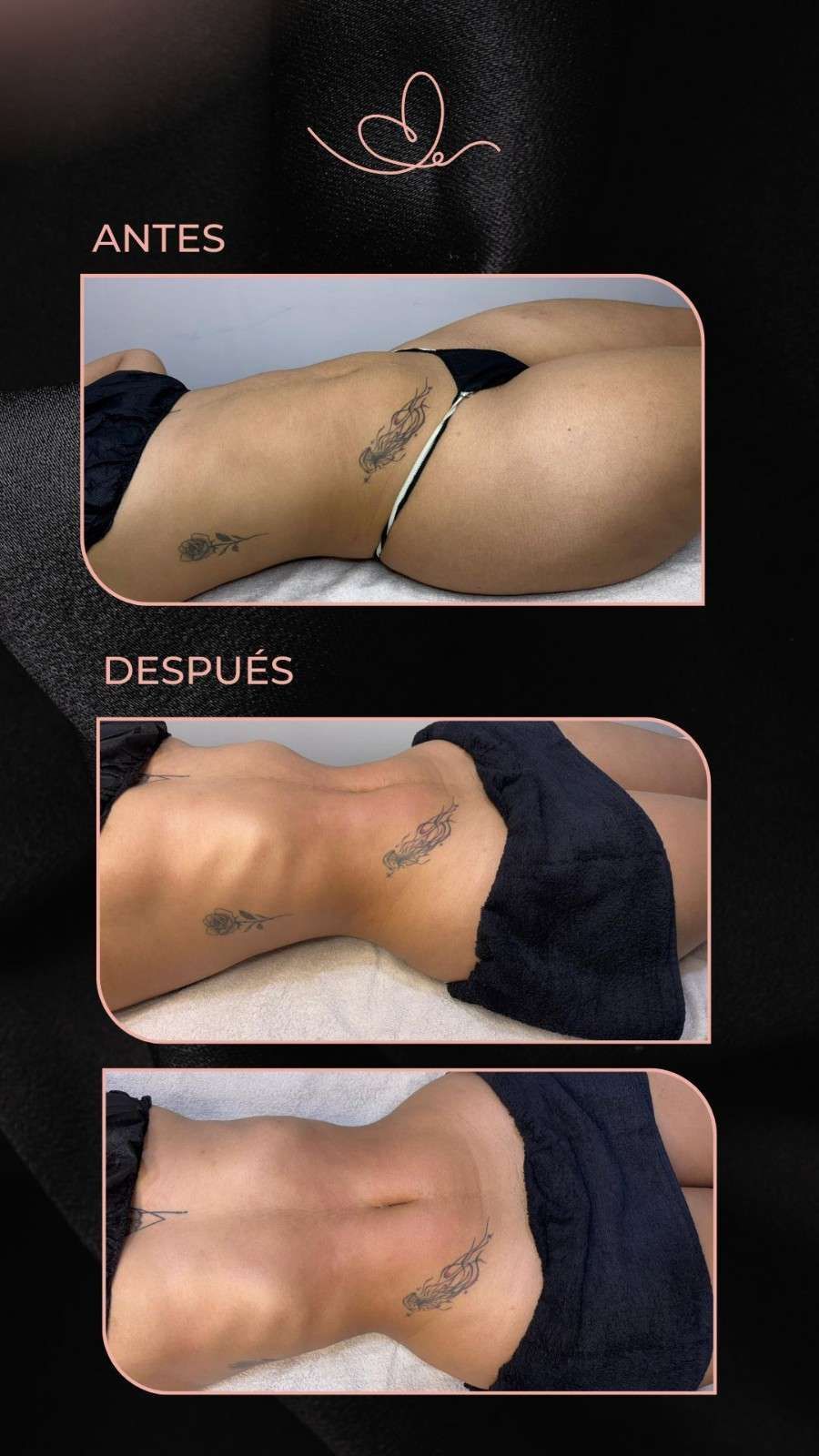 Manos masajeando la espalda desnuda de una persona durante un tratamiento de spa.