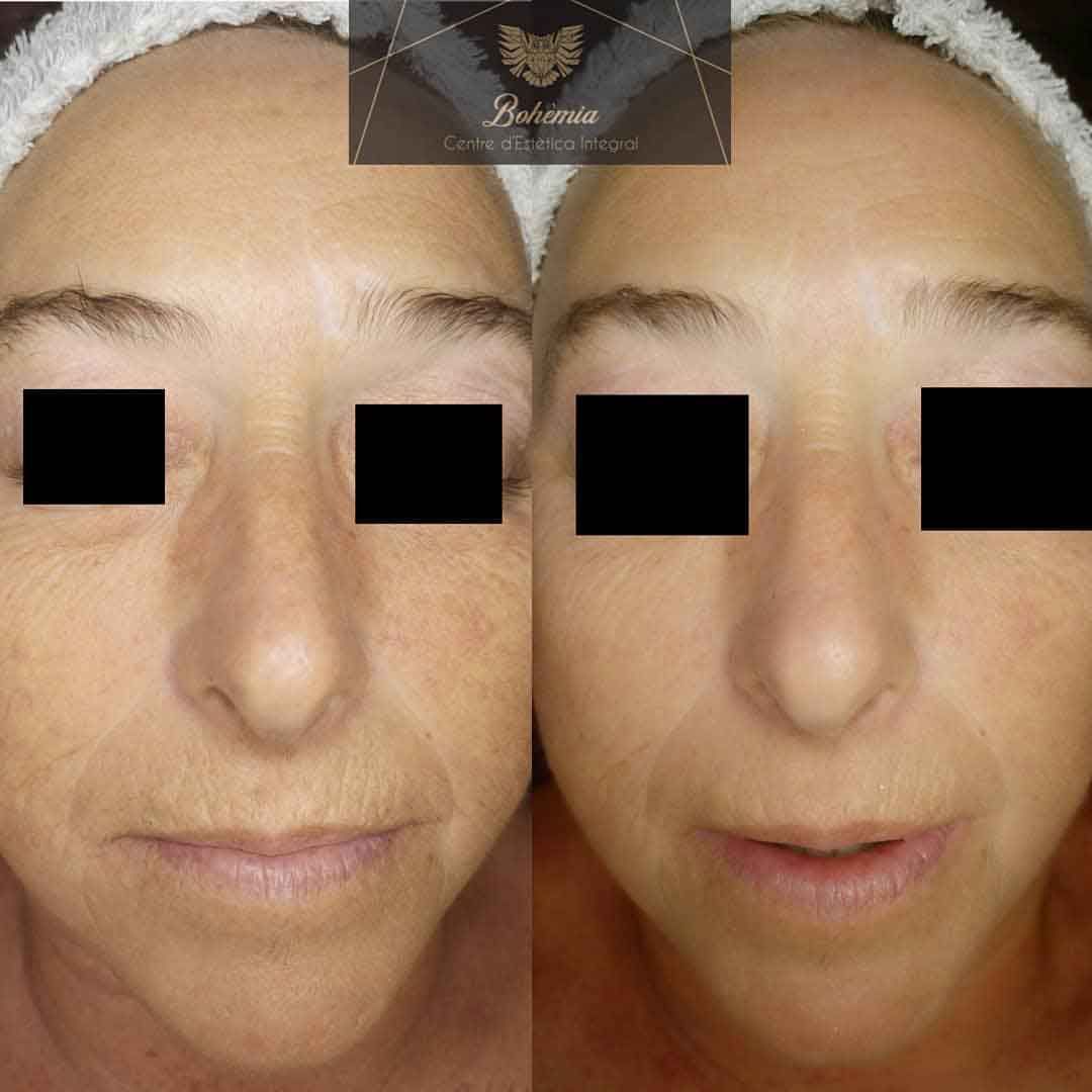 Una foto de antes y después del rostro de una mujer.