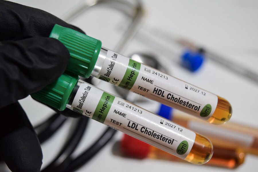 Mano enguantada sosteniendo tubos de ensayo de sangre para colesterol HDL y LDL 