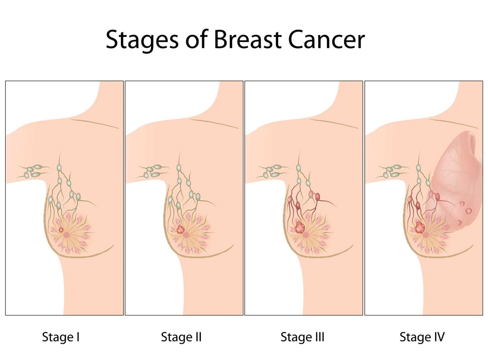 Στάδια Καρκίνου Μαστού