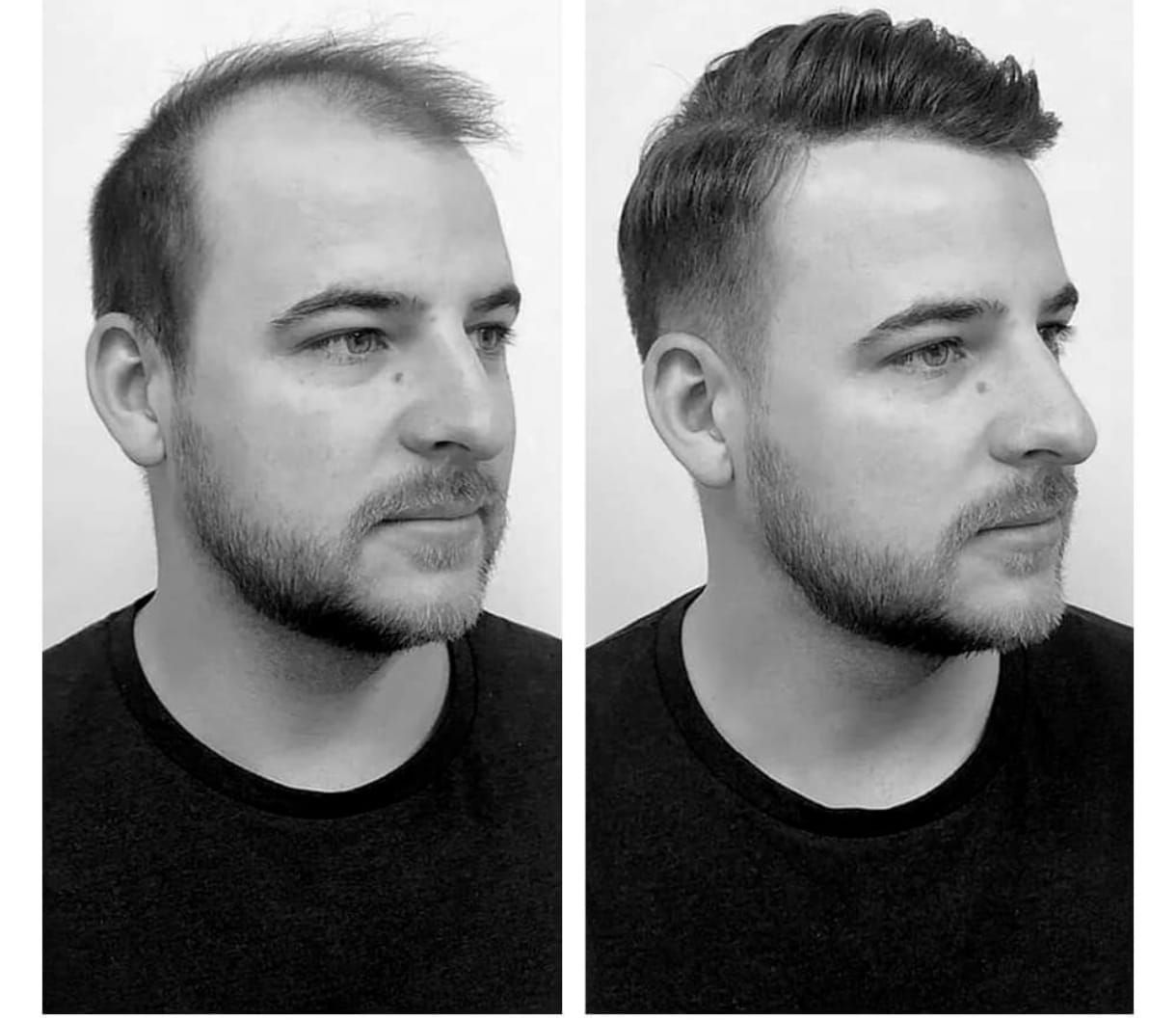 Un homme portant un tee-shirt noir avant et après pose de complément capillaire.