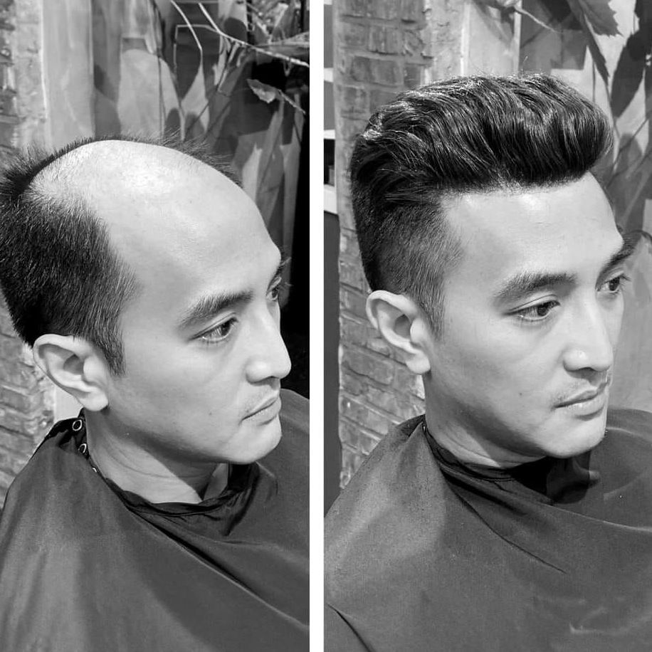 Un homme souffrant de perte de cheveux avant et après pose de complément capillaire.