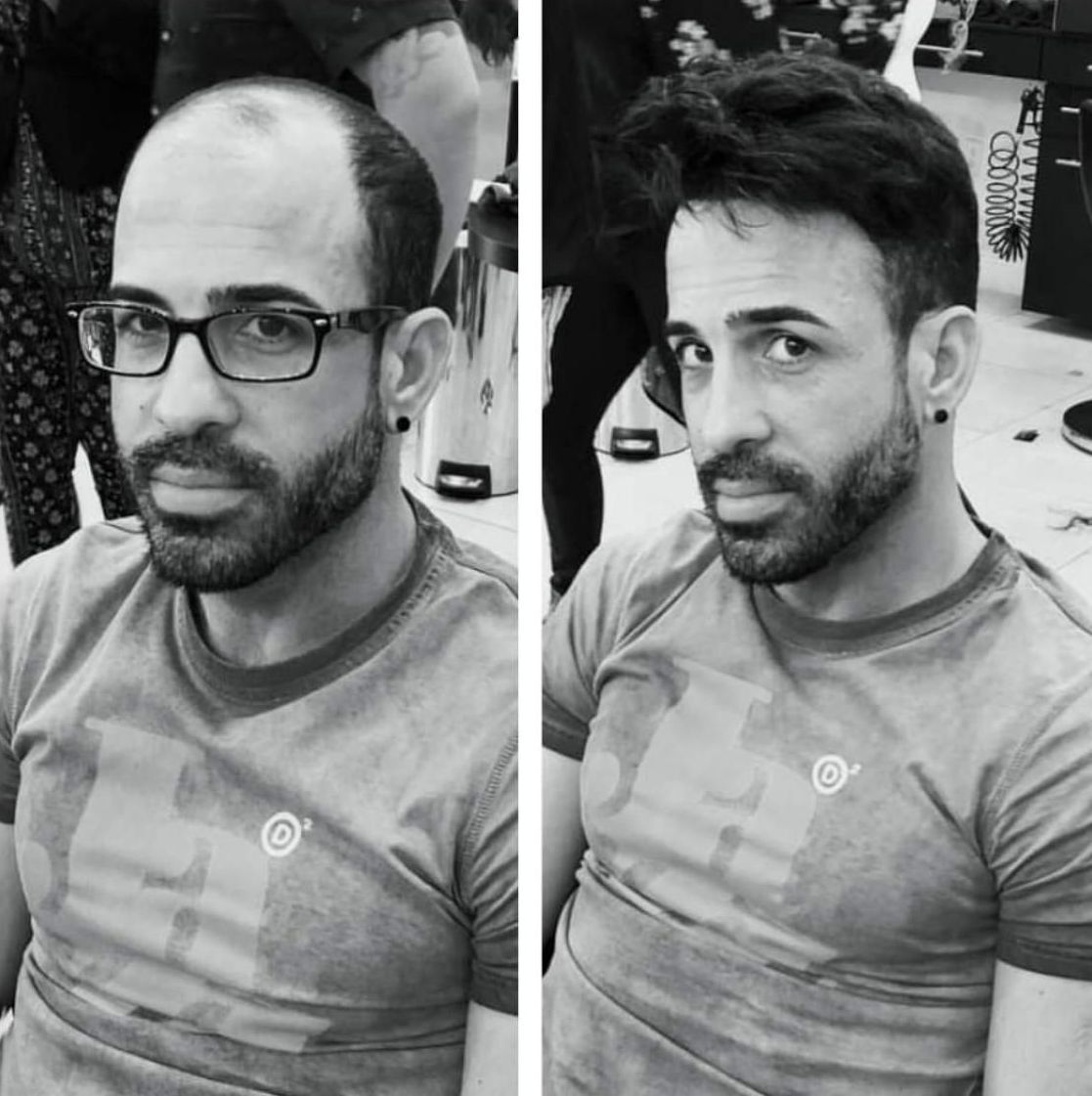Un homme portant des lunettes avant et après pose de complément capillaire.