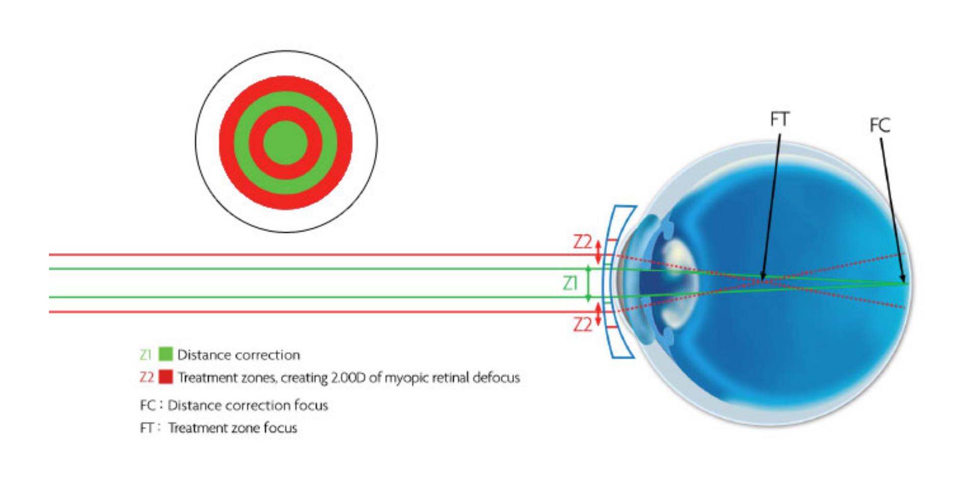 Diagrama de un ojo con un patrón de círculos concéntricos. Muestra zonas para la corrección de la visión de lejos y de cerca, con puntos de enfoque.