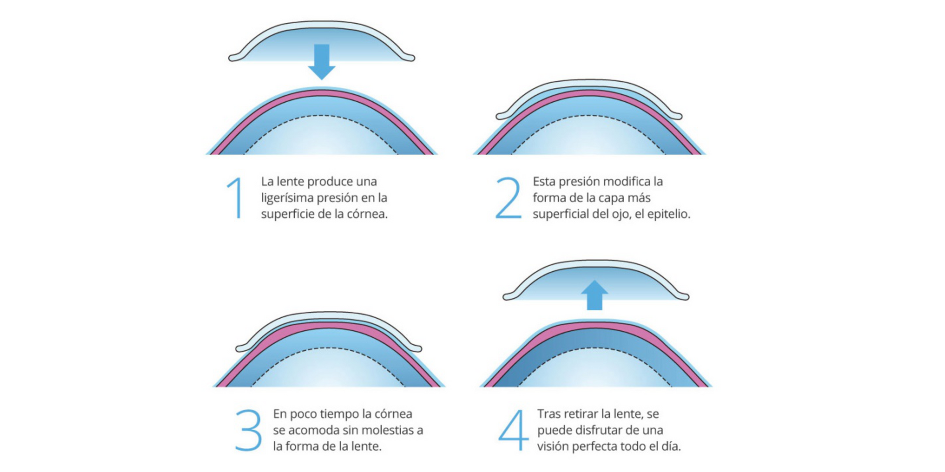 Diagrama que muestra los pasos de un procedimiento de implante de córnea. Se coloca una lente sobre la córnea y se presiona hacia abajo.
