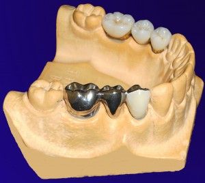 Dr. Klaus-Uwe Kaufhold Einzelkronen 3