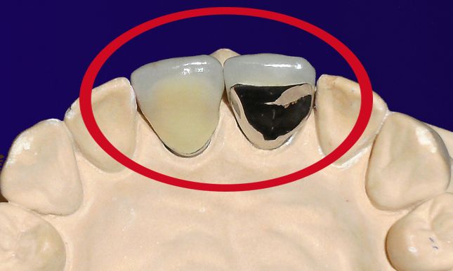 Dr. Klaus-Uwe Kaufhold Einzelkronen 2