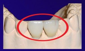 Dr. Klaus-Uwe Kauhold Einzelkronen 1