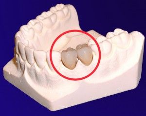 Dr. Klaus-Uwe Kaufhold Einzelkronen 3