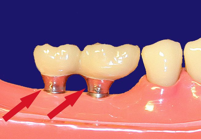 Dr. Klaus-Uwe Kaufhold Einzelkronen 2