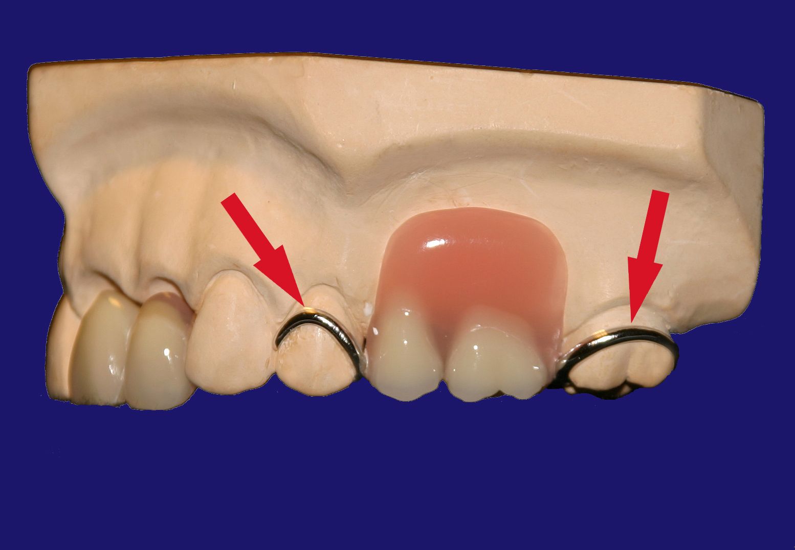 Dr. Klaus-Uwe Kaufhold Einzelkronen 2