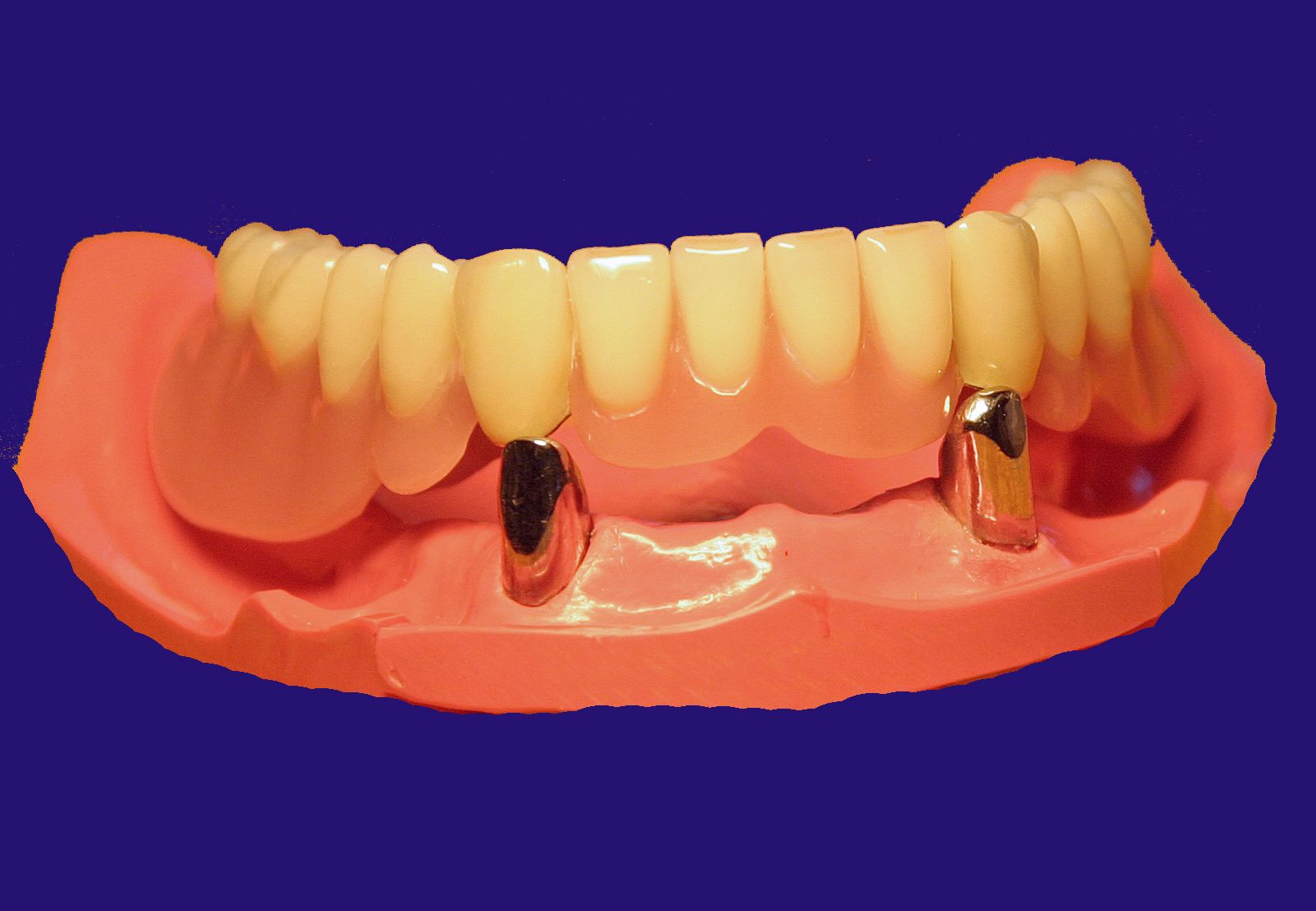 Dr. Klaus-Uwe Kaufhold Einzelkronen 2