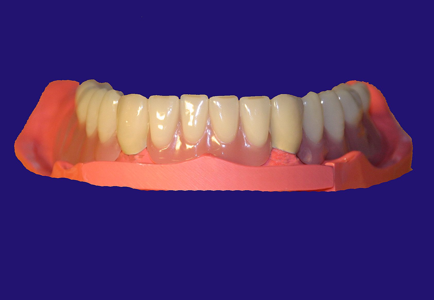 Dr. Klaus-Uwe Kauhold Einzelkronen 1