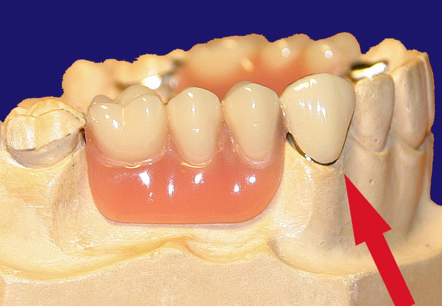 Dr. Klaus-Uwe Kaufhold Einzelkronen 2