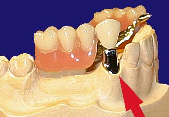 Dr. Klaus-Uwe Kauhold Einzelkronen 1