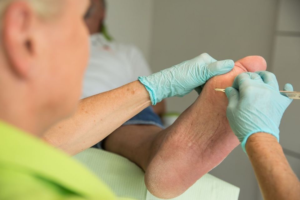 Behandlung von Hühneraugen in der Praxis für Podologie Rheintal GmbH