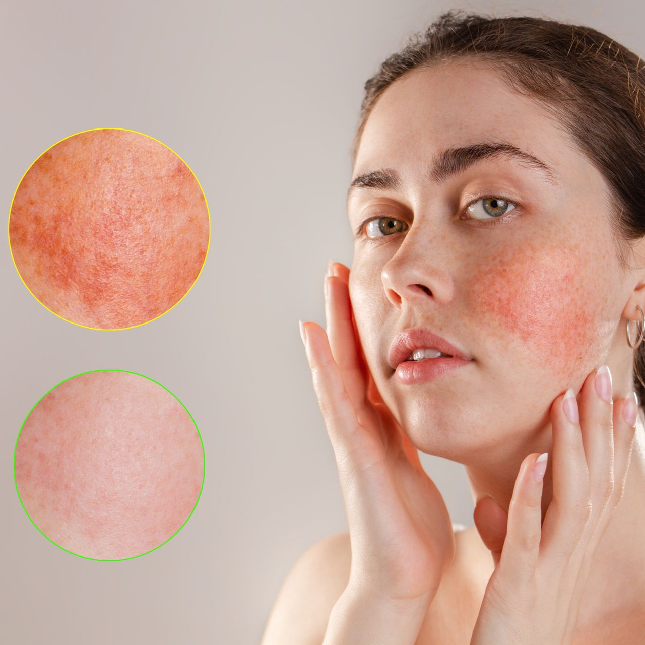 Couperix peel για ροδοχροϊκά δέρματα 
