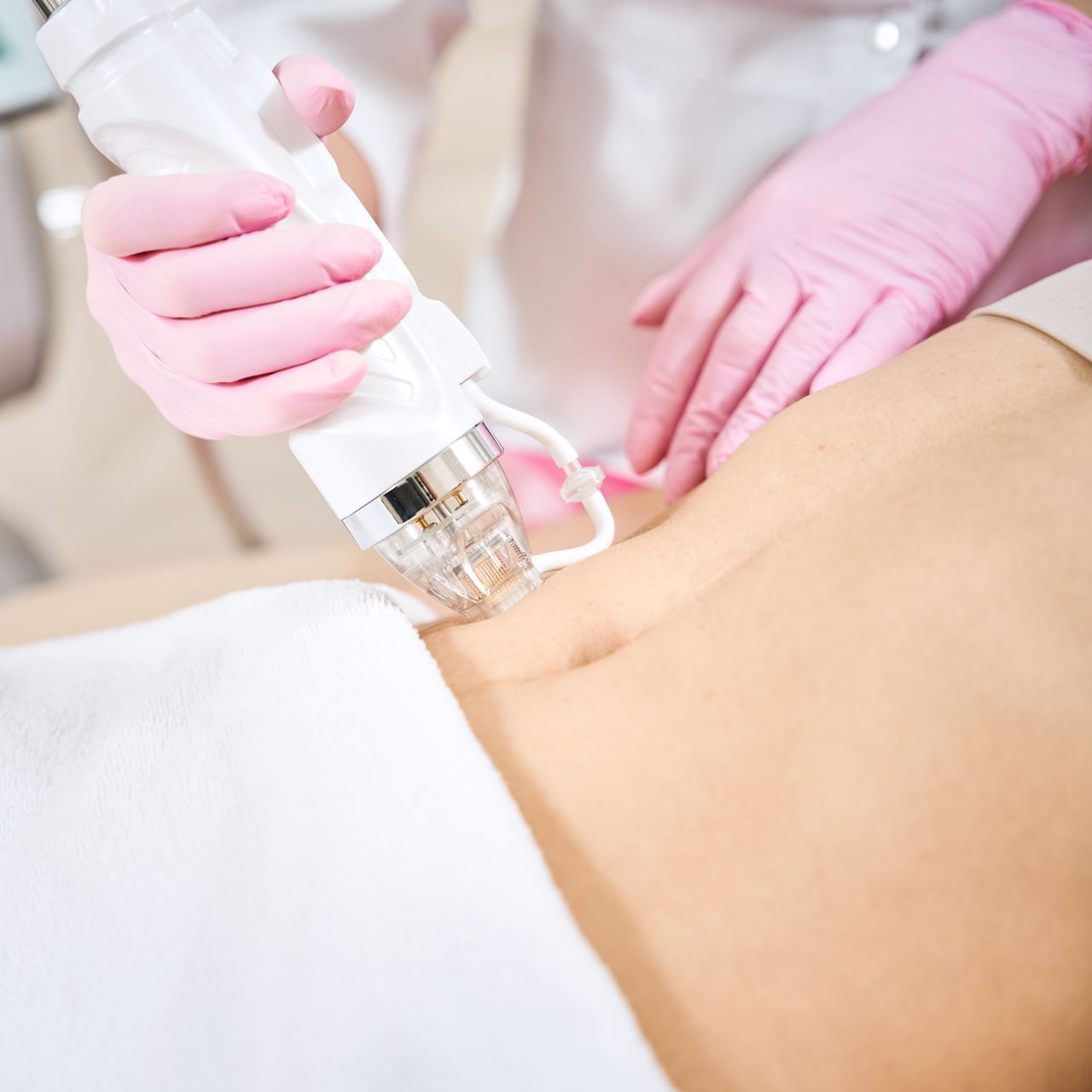 Fractional RF & RF Microneedling Fractional RF & RF Microneedling