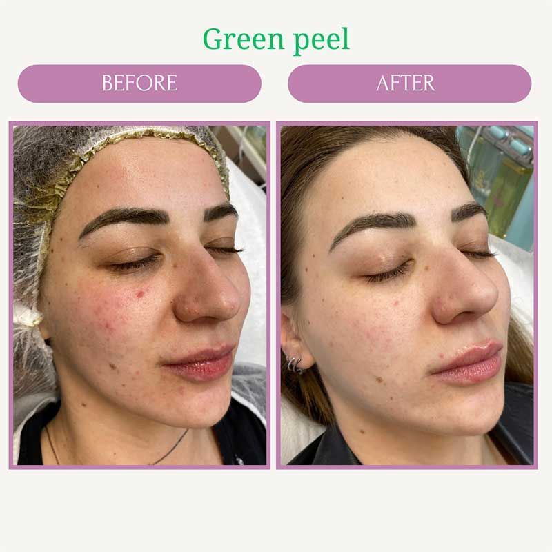 Green Peel