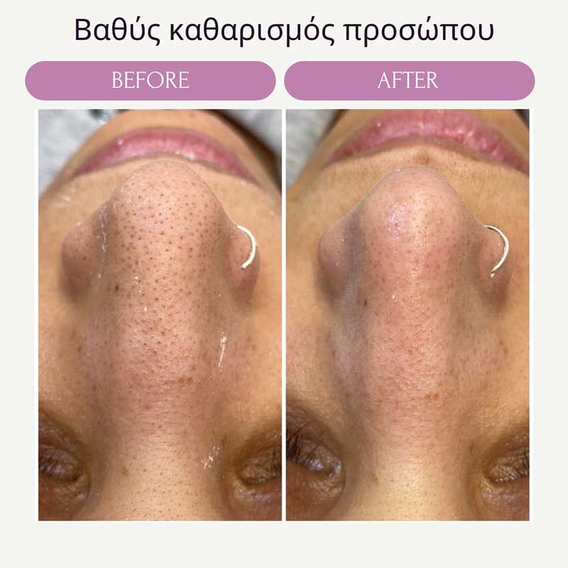 Βαθύς καθαρισμός προσώπου