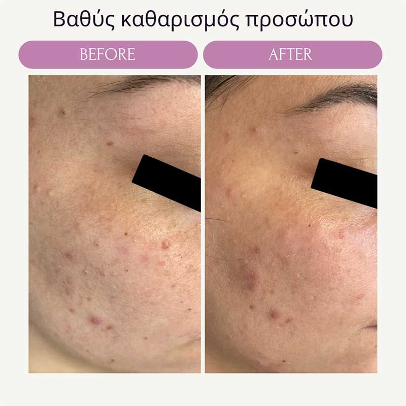 Βαθύς καθαρισμός προσώπου