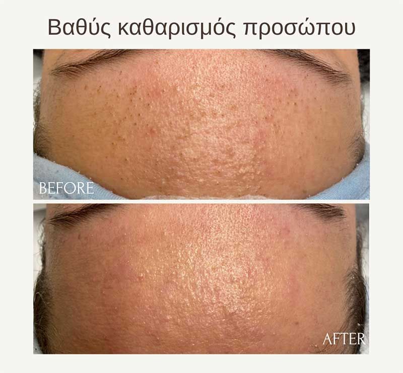 Βαθύς καθαρισμός προσώπου